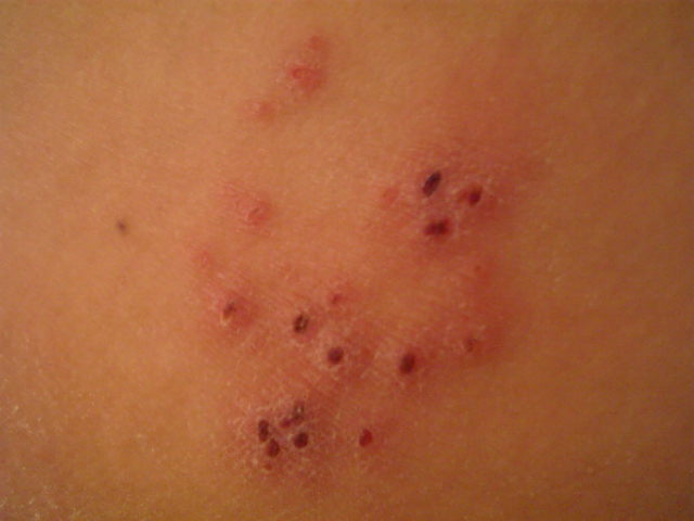 herpes zoster pic #11