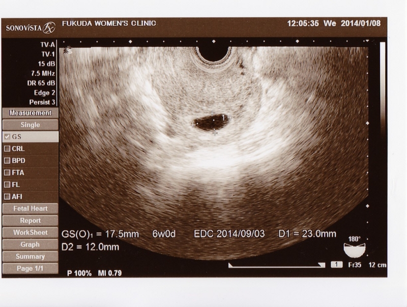 出産予定日 胚盤胞